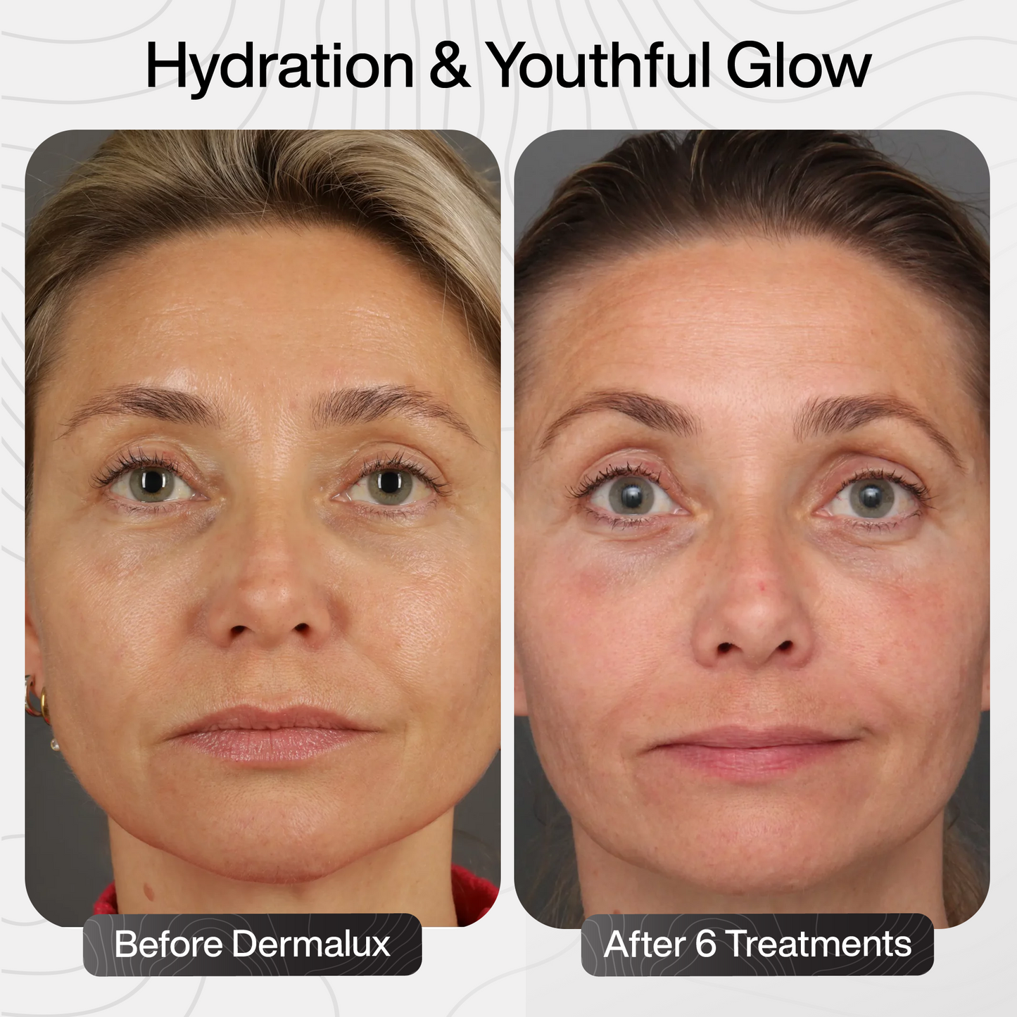 PDRN Advanced Infusion Treatment