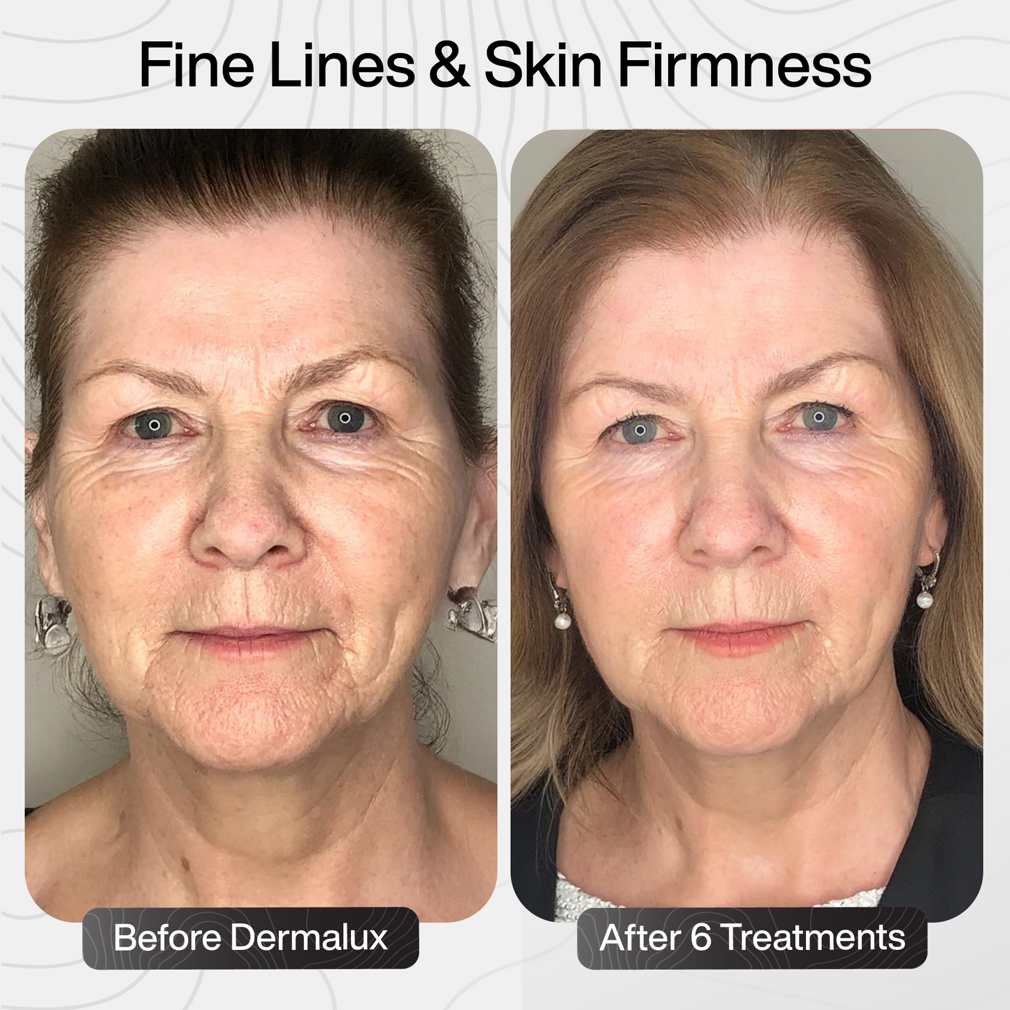 PDRN Advanced Infusion Treatment